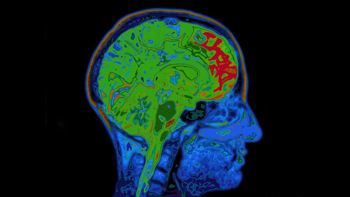 An MRI of a human skull and brain.