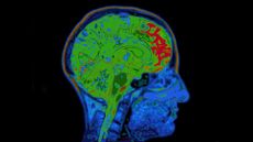 An MRI of a human skull and brain.