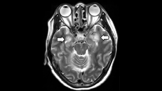 An MRI scan from a woman who tested positive for COVID-19 revealed evidence of tissue damage.