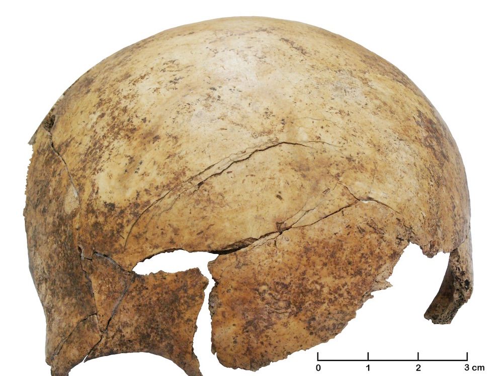 Neolithic skull injury 