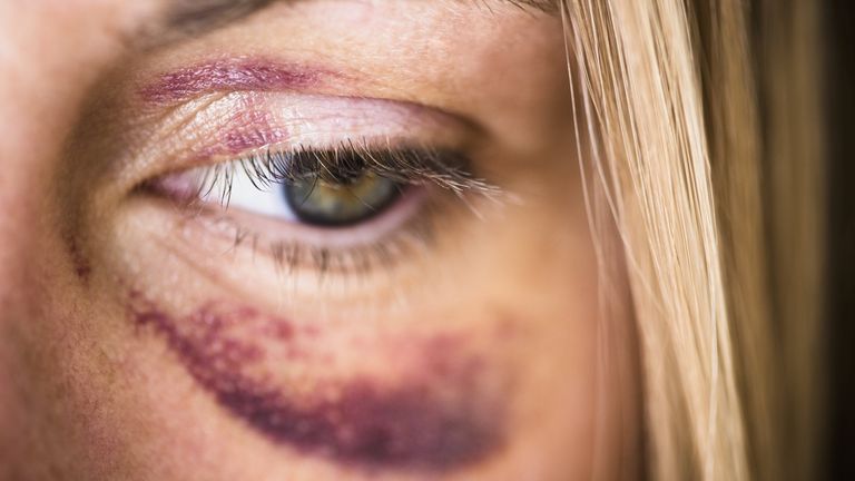 Woman Bruised Eye