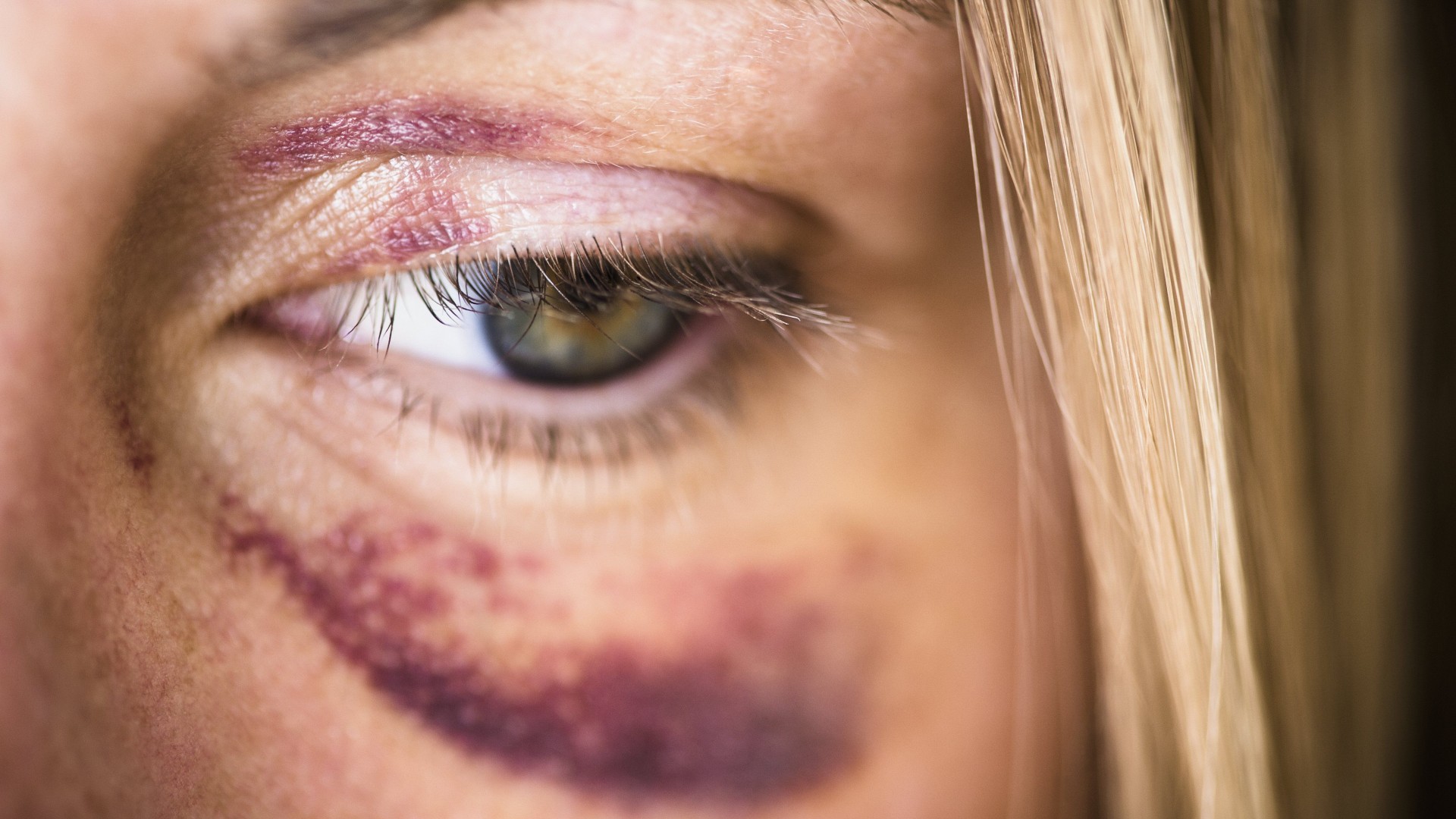 Woman Bruised Eye