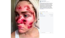 skin cancer, selfie, tawny willoughby
