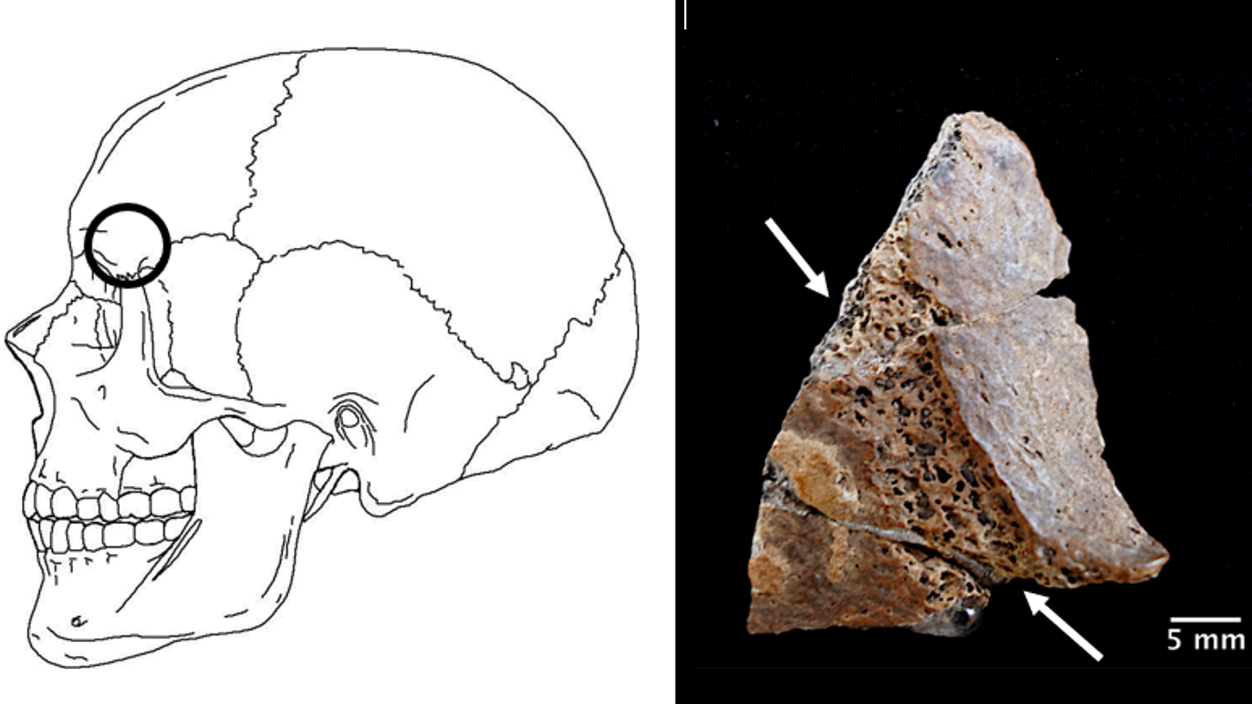 A left-side view of a line drawing of a human skull with a circle over the temple area; on the right, a chunk of skull bone that has been removed and shows injury