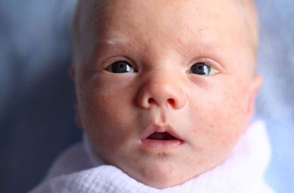 baby milk spots in newborn 