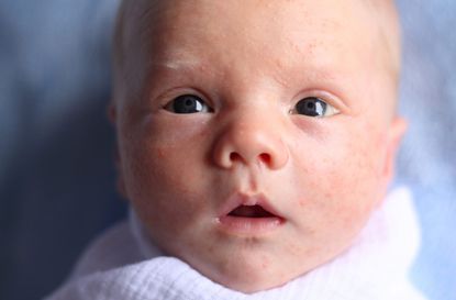 A small baby with either newborn milk spots or baby acne, looking up past the camera.