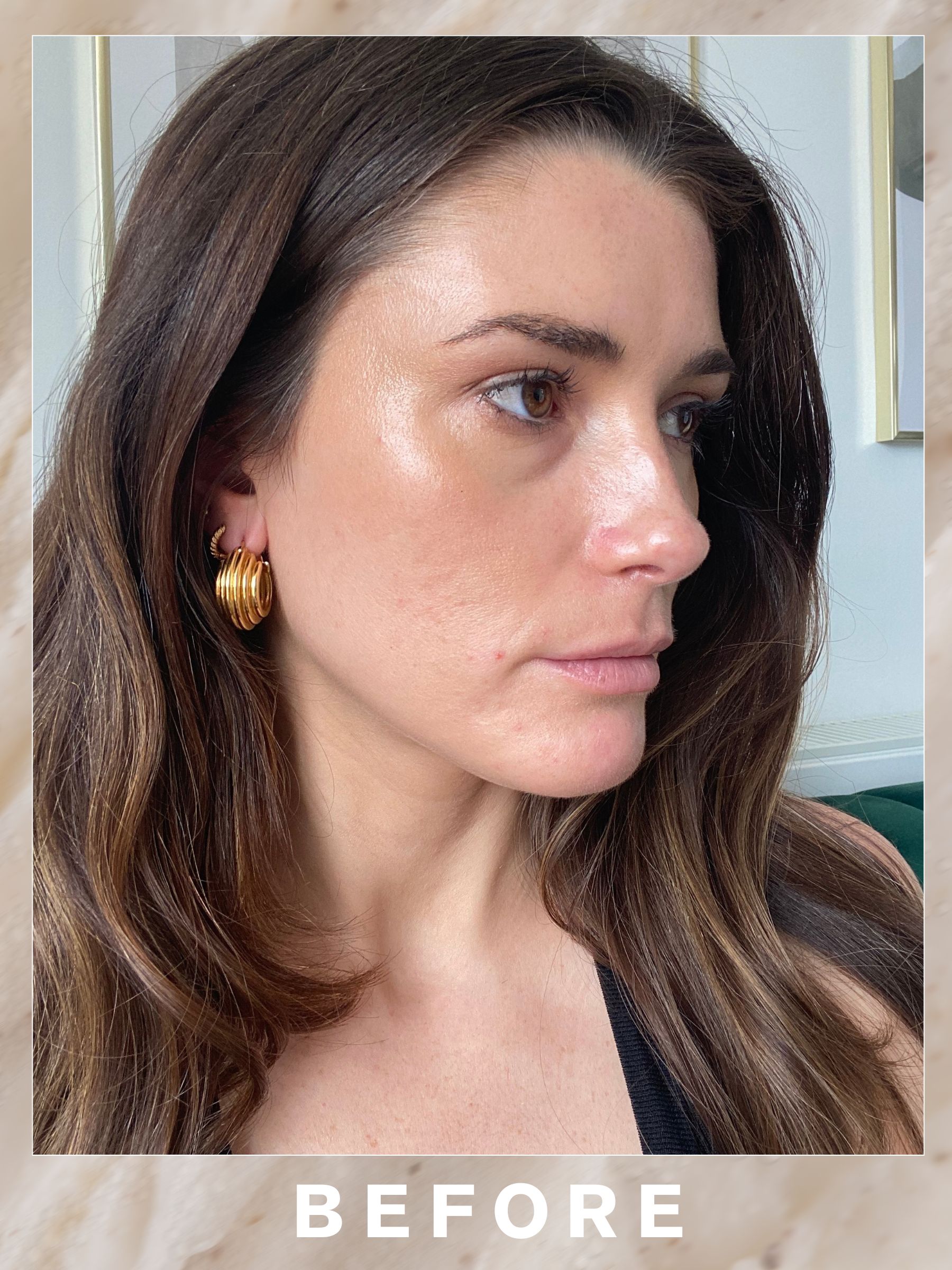 Eleanor&#039;s skin before RF microneedling