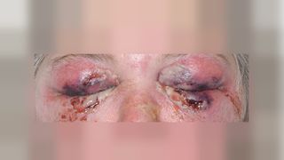 A woman developled severe swelling around both her eye sockets, as well as pus discharging from her eyes, as a result of an infection with "flesh-eating" bacteria.