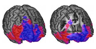 MRI scans of a human brain show the regions significantly associated with decision-making in blue, and the regions significantly associated with behavioral control in red. On the left is an intact brain seen from the front — the colored regions are both in the frontal lobes. The image on the right is that same brain with a portion of the frontal lobes cut away to show how the lesion map looks in the interior.