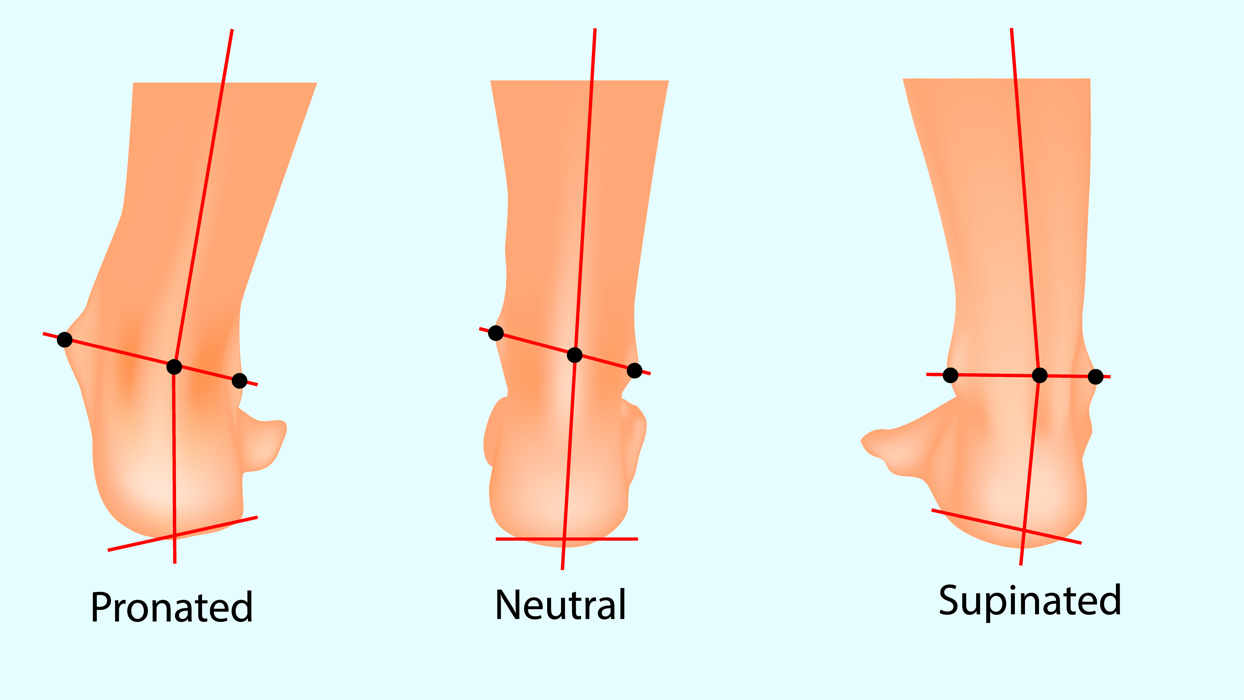 Image showing supination vs overpronation