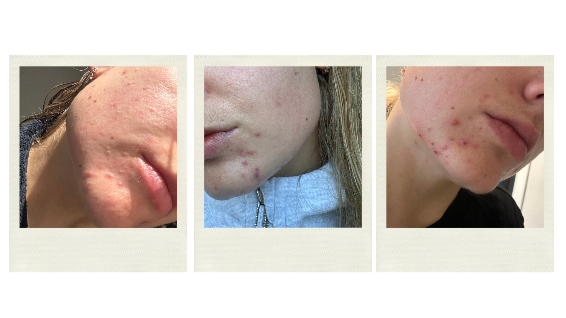 Alice skin acne