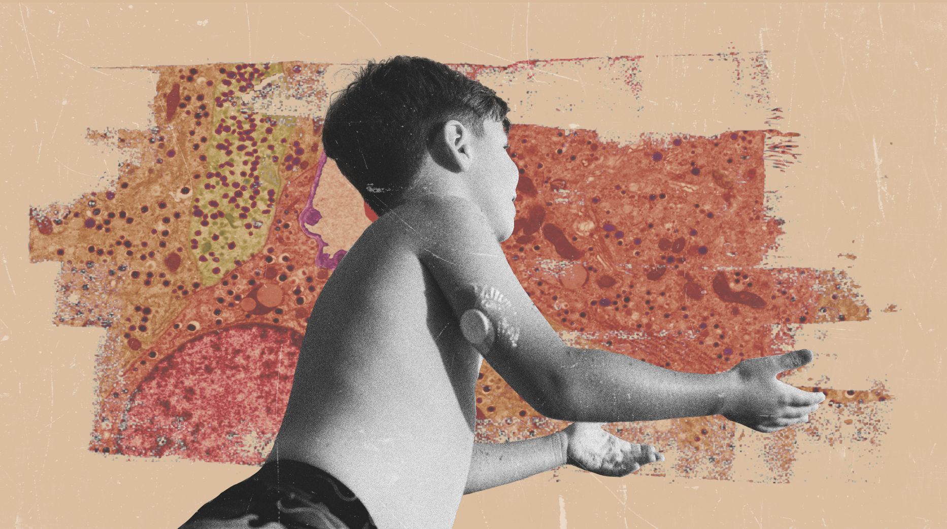 a photocollage of a young boy with a glucose monitor playing, with a background of cell microscopy