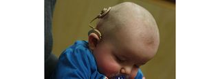 Baby with cochlear implant