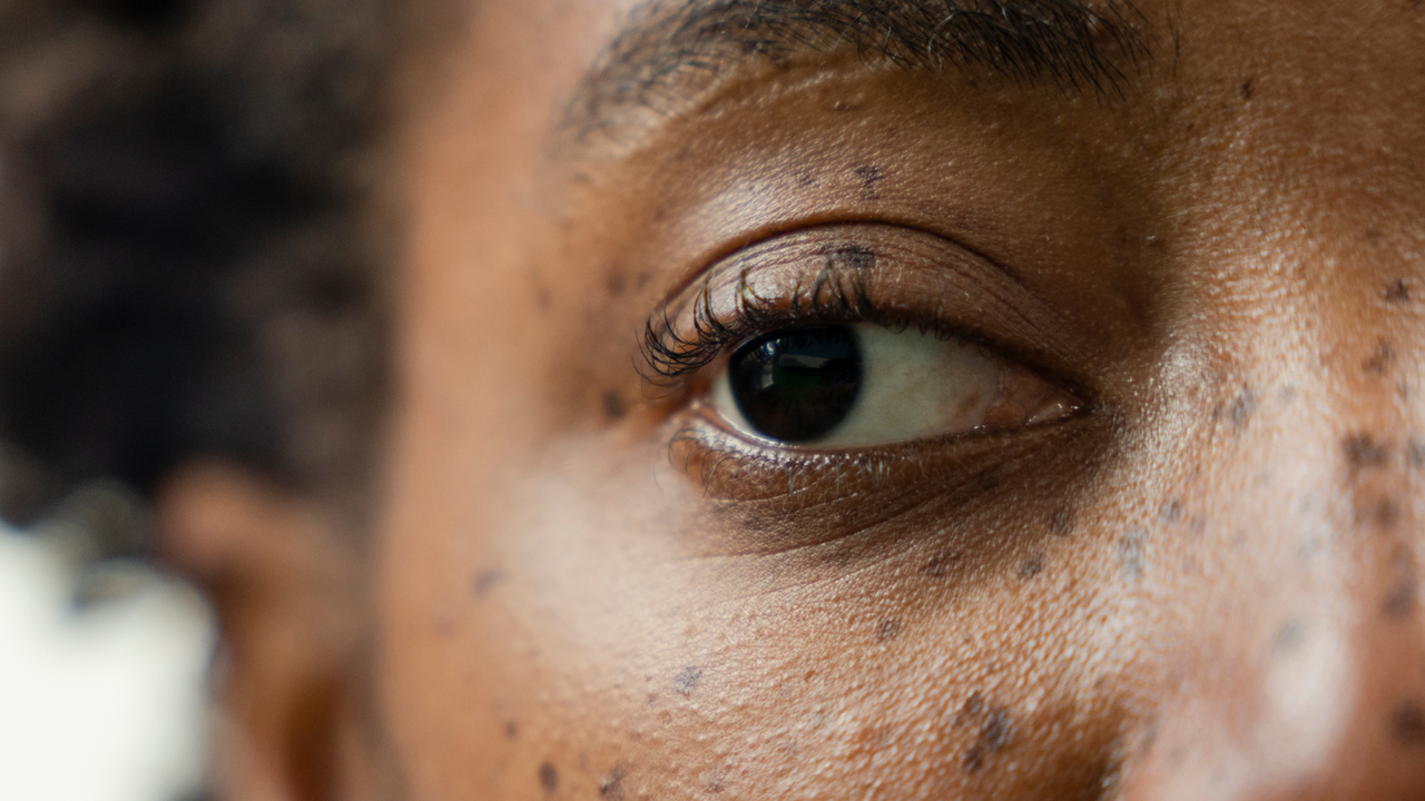 Injecting anesthetic into a 'lazy eye' may correct it, early study suggests