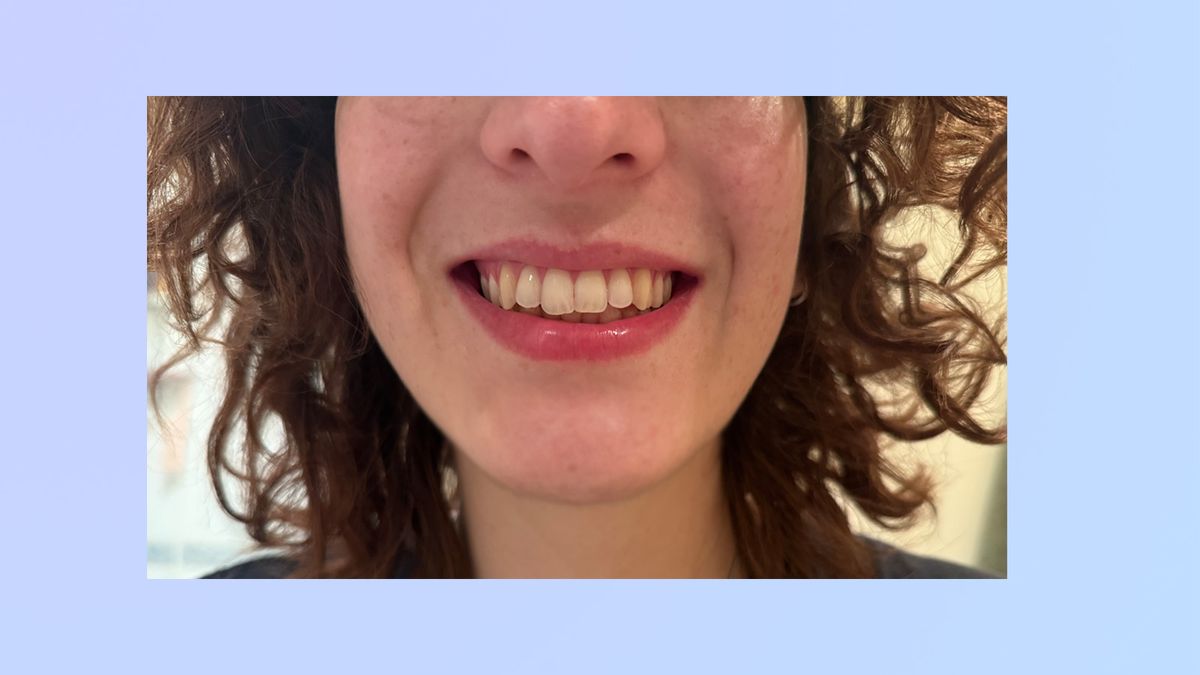 a photograph of the author's teeth after using the suri 2.0 brush