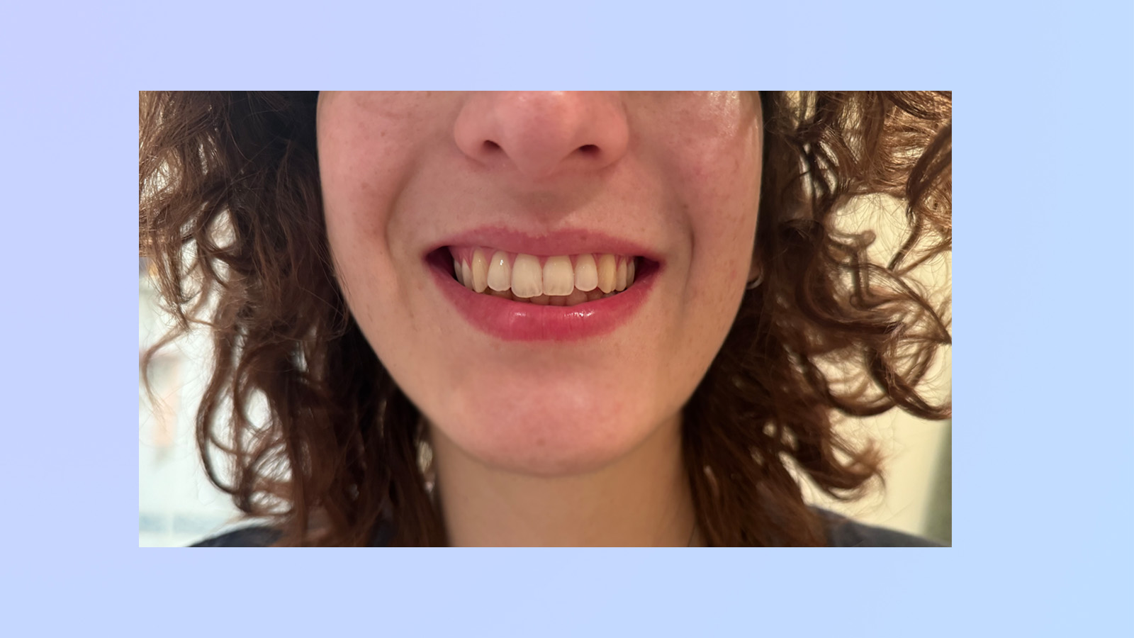 a photograph of the author's teeth after using the suri 2.0 brush