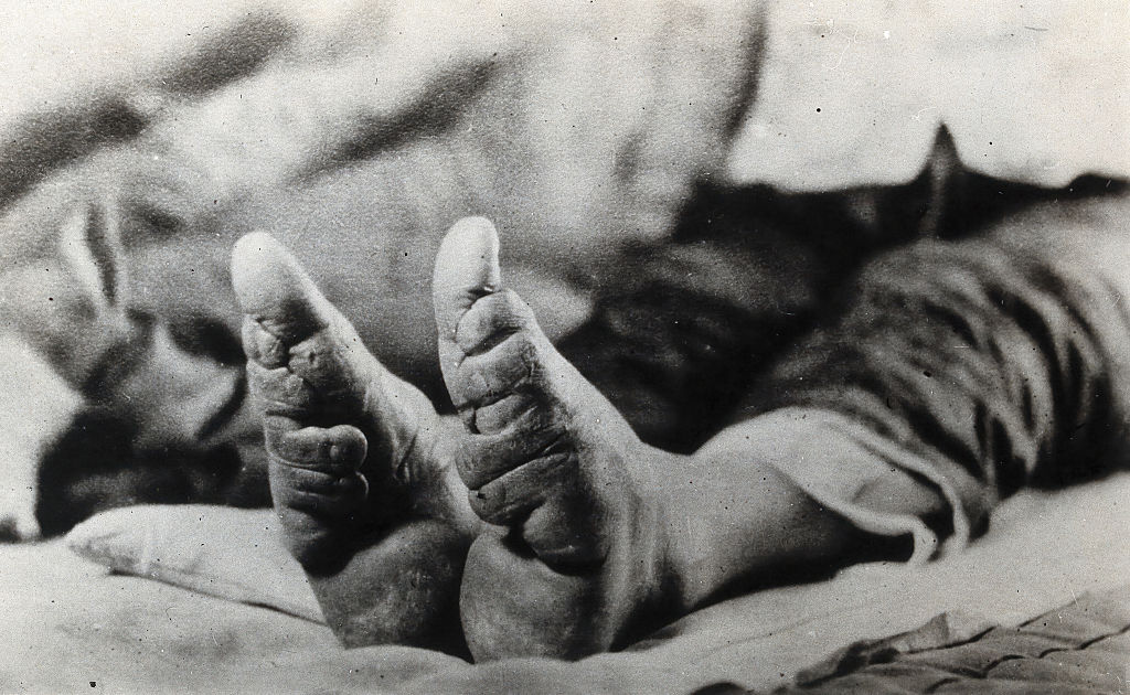 A black and white photo shows a small pair of feet with the toes compressed against the bottom of the foot.