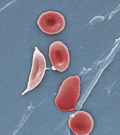 Sickle cell and normal red blood cells.