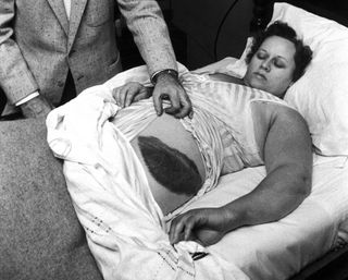 a woman lies with her rump exposed, showing a blackened mark left by a falling meteorite.