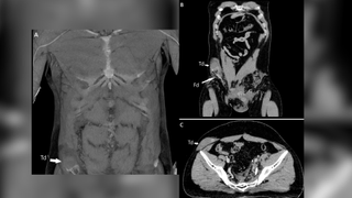 3 images from CT scans of the man's body showing the right testicle that was dislocated into his abdomen; his torso is shown from the front, from above and from the side