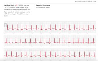 My partner's ECG showing an average heart rate of 114