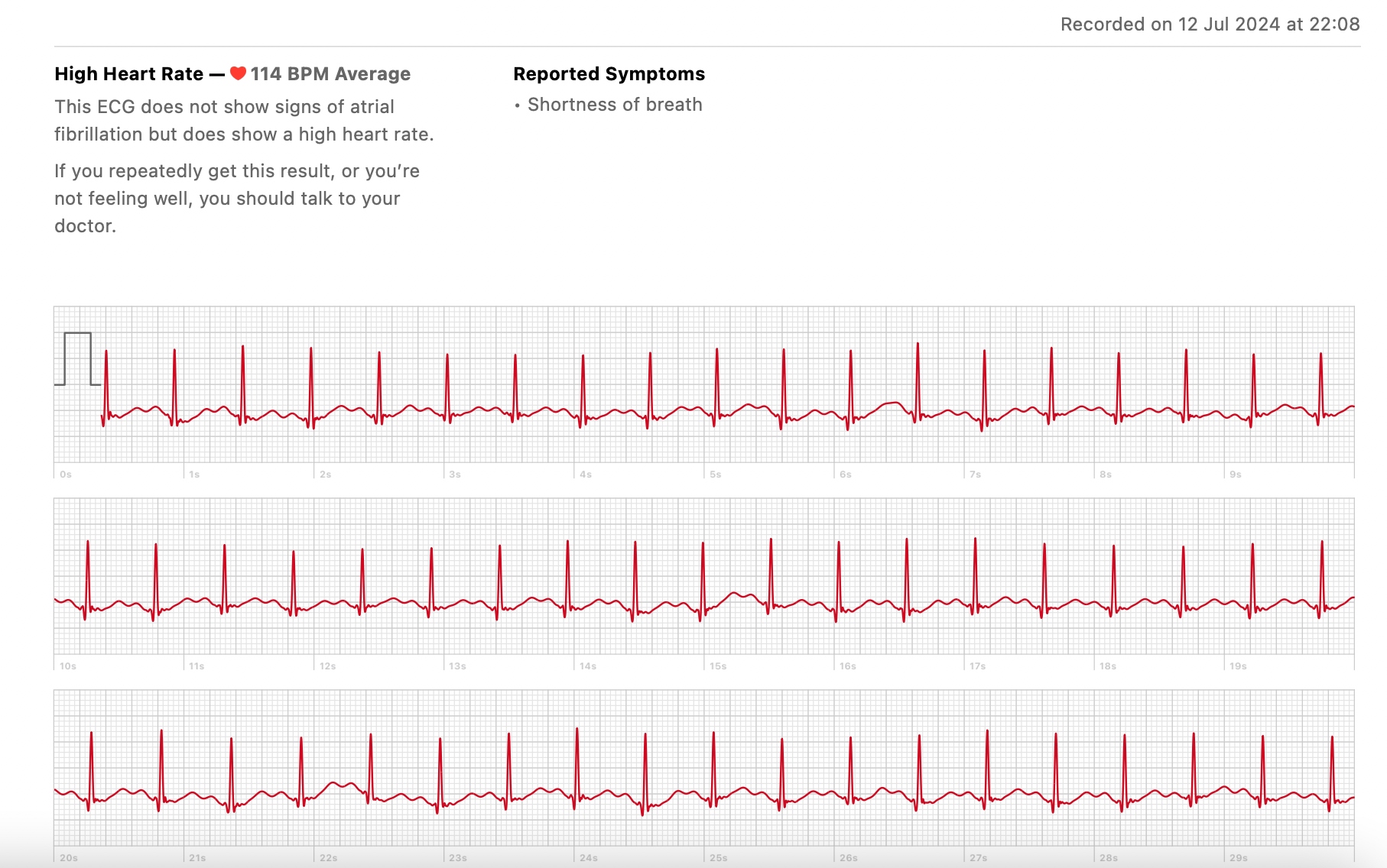 My partner's ECG showing an average heart rate of 114