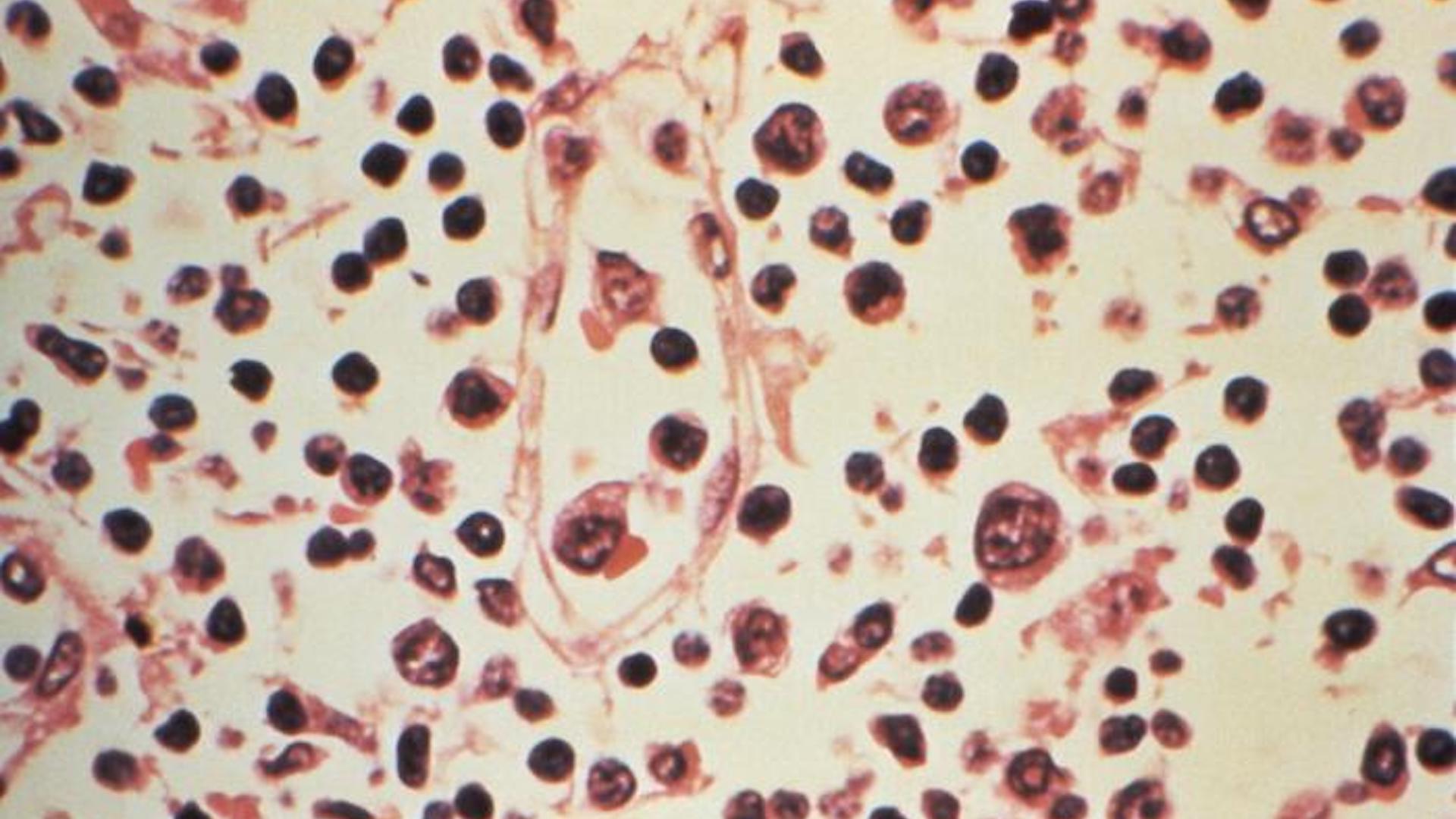 A laboratory image of lymph node sampled from a person with a hantavirus infection