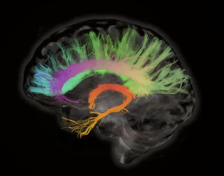 cross section of the human brain shows white matter tracts, meaning bundles of long wires between brain cells, depicted in bright colors