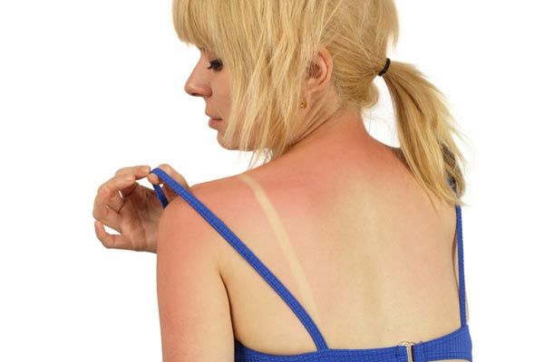 Sunburn: Causes, Symptoms & Treatment | Live Science