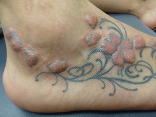 Tattoos Can Cause Serious Adverse Reactions