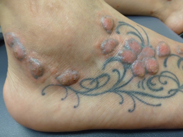 Woman dealing with tattoo nightmare says skin is burning, peeling off