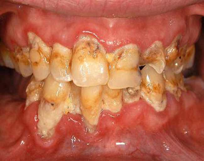 meth before and after pictures teeth