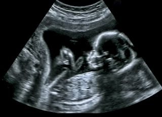 Ultrasound of baby.