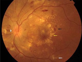 High blood pressure caused by preeclampsia damaged a woman's eye, leading to blurry vision. Above, an image of the interior surface of the eye. Black arrows indicate hemorrhages, and arrow heads indicate swelling of the optic disc.