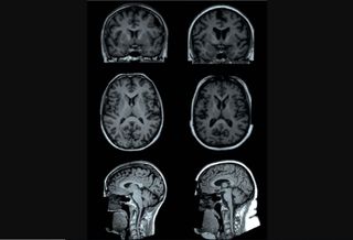 Association of body mass index and waist-to-hip ratio with brain structure