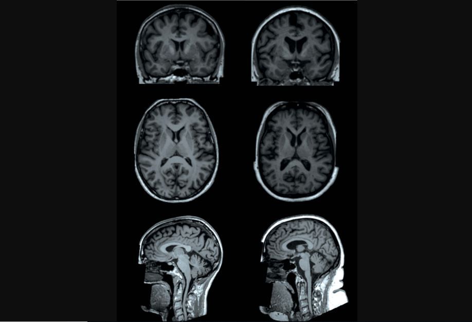 A new study finds that higher levels of body fat are tied to lower brain volumes in certain areas. Above, brain MRI scans of two participants in the study (both are women age 65 years old). One participant had a body fat percentage of 13% (left), and the 