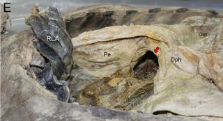 Congenital hernia showed up in the diaphragm (arrows) during dissection of the thoracic and abdominal cavities of the Korean mummy. The liver can be seen protruding through the hernia in this image.