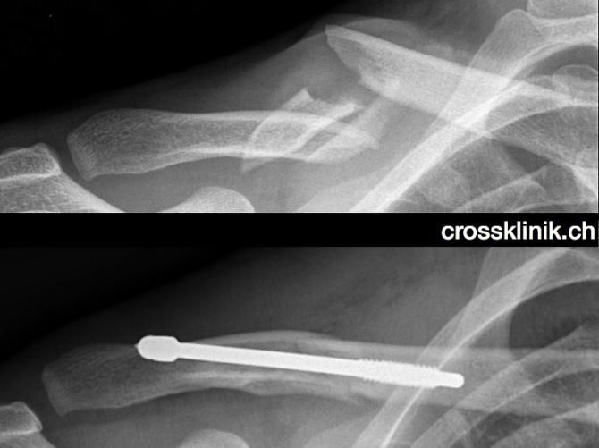 Before and after... the broken collarbone of Fabian Cancellara suffered at the Tour of Flanders