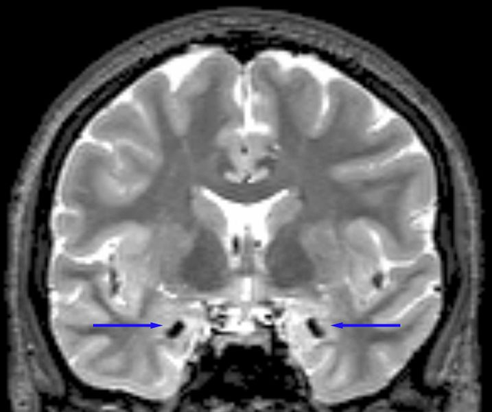 A close up photo of a grayscale brain scan, with blue arrows pointing to specific black dots on the scan.