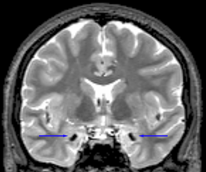 A close up photo of a grayscale brain scan, with blue arrows pointing to specific black dots on the scan.
