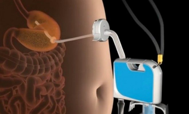 The AspireAssist empties 30 percent of the contents of a person&amp;#039;s stomach into the toilet.