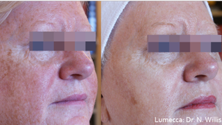 Lumecca before and after treatment to get rid of liver spots