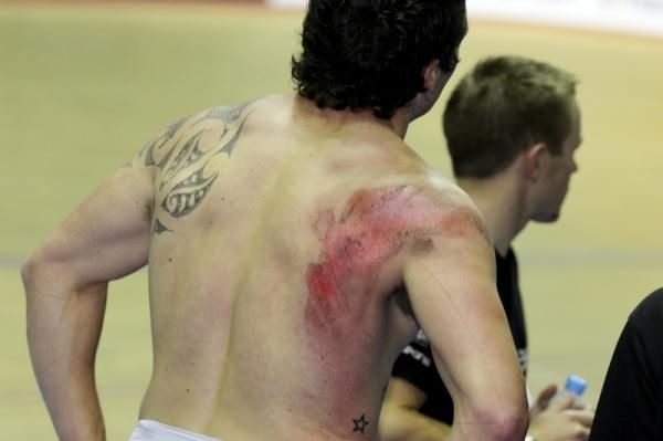 Eddie Dawkins is missing a bit of skin after that crash.