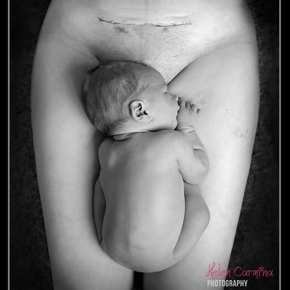 C-section Helen Aller