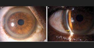 Copper-color rings around a man's irises helped doctors diagnose his genetic disease. The rings, shown above, are known as Kayser–Fleischer rings and are a sign of Wilson's disease. Image on the right shows a slit-lamp examination of the man's eye in which copper deposits can be seen in a part of the eye known as the Descemet’s membrane.