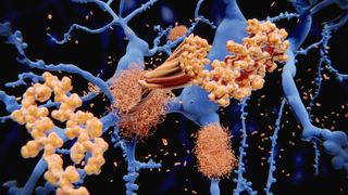 illustration depicts amyloid-beta peptides, the building blocks of amyloid-beta plaques, building up in the brain among individual neurons