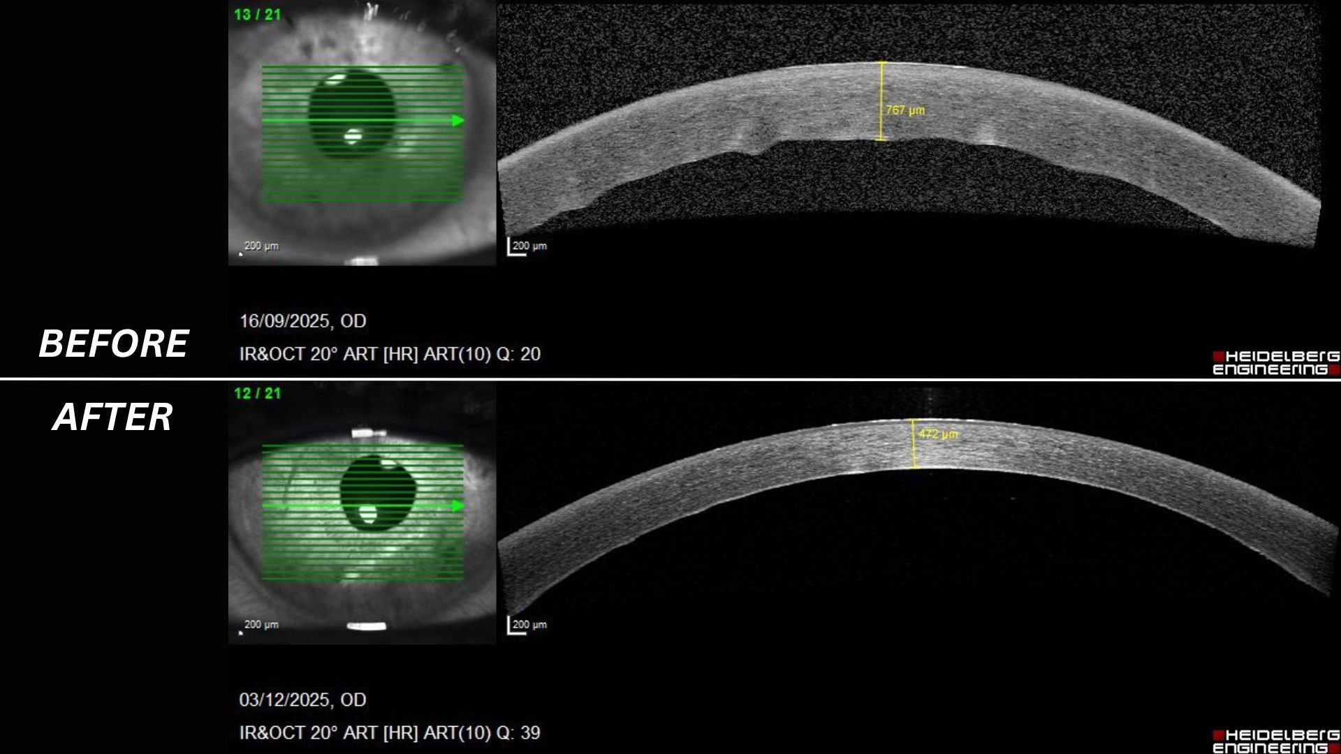 Two images show medical scans of a person's cornea, before and after a transplant procedure 