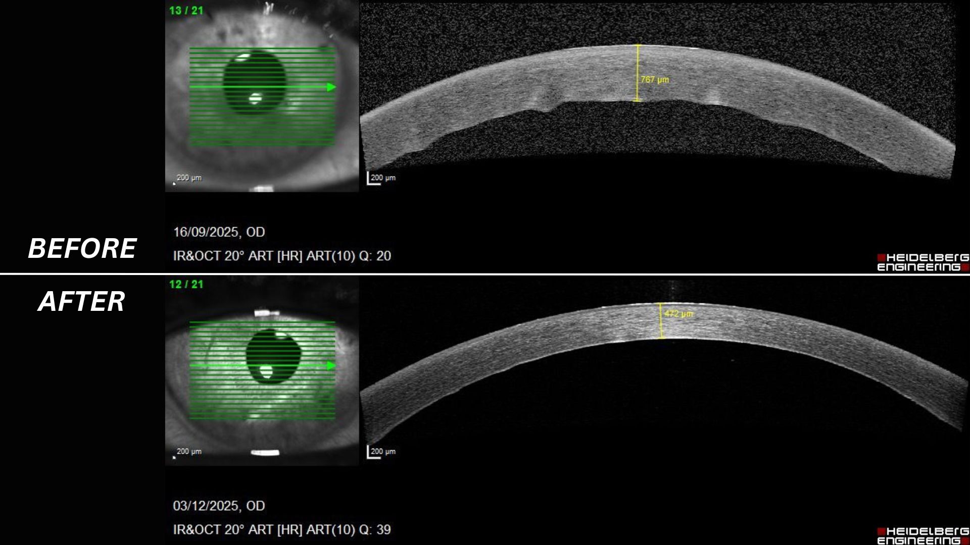 Two images show medical scans of a person's cornea, before and after a transplant procedure 