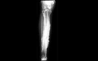 A rare condition called melorheostosis causes excess bone formation, and makes people's bones appear to drip or flow like candle wax on X-rays.