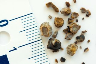 Kidney stones broken into smaller pieces after lithotripsy.